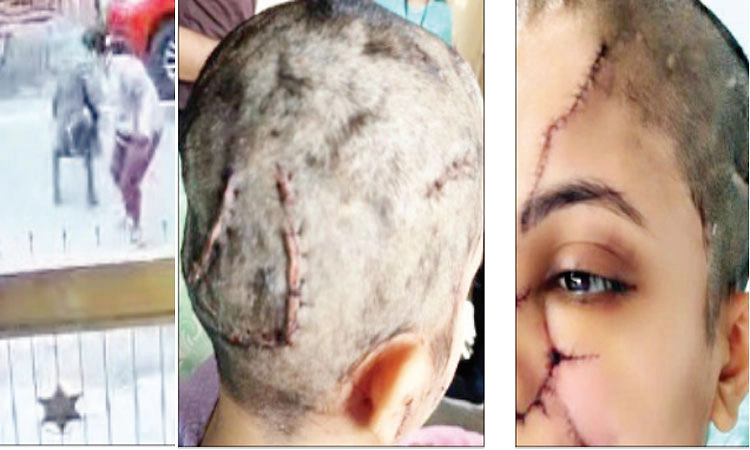 ಮಹಿಳೆಗೆ ಸಿಕ್ಕ ಸಿಕ್ಕ ಕಡೆ ಕಚ್ಚಿದ ಸಾಕು ನಾಯಿ!; 30ಕ್ಕೂ ಹೆಚ್ಚು ಭಾಗಗಳಿಗೆ ಹೊಲಿಗೆ!