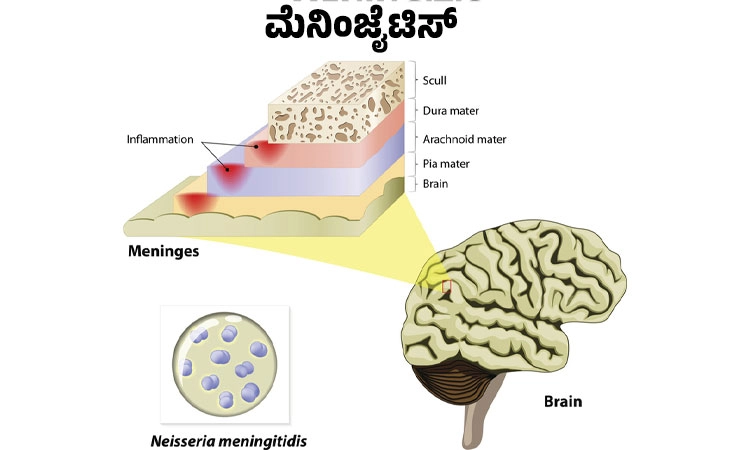 Meningitis: ಮೆನಿಂಜೈಟಿಸ್‌ ಲಕ್ಷಣಗಳು, ಕಾರಣಗಳು, ಅಪಾಯಗಳು, ಪ್ರಸರಣ ಮತ್ತು ಚಿಕಿತ್ಸೆ