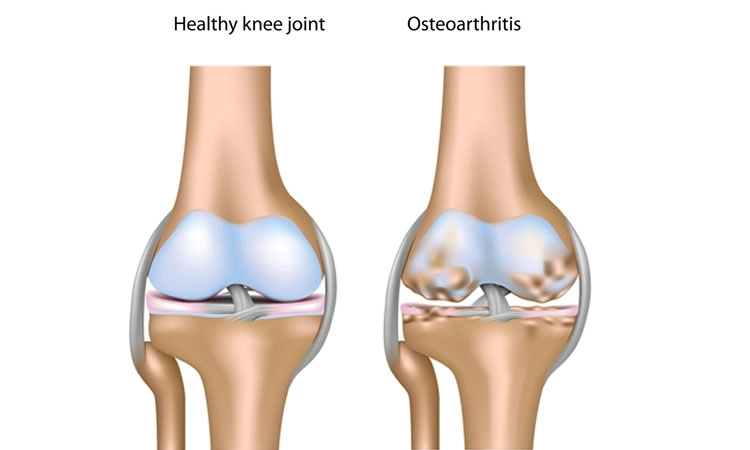 Osteoarthritis, Knee Osteoarthritis: ಮೂಳೆ ಸವೆತ ಹಾಗೂ ಮಂಡಿ ಸವೆತ