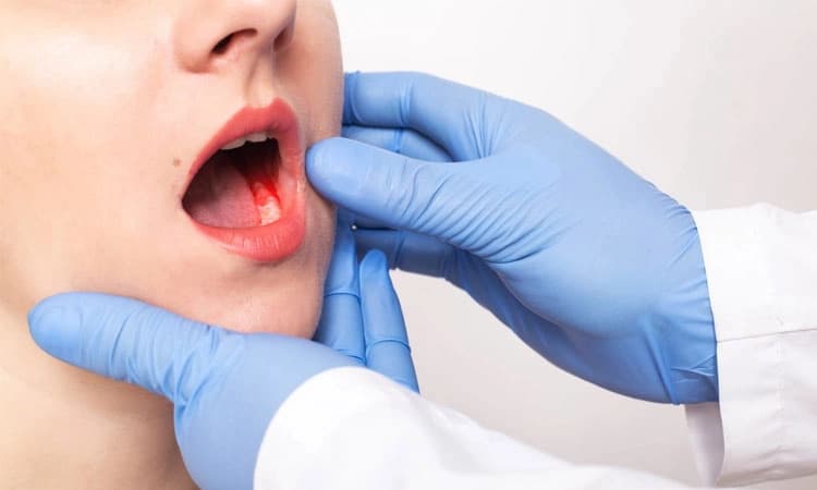 Oral cancer: ಬಾಯಿಯ ಕ್ಯಾನ್ಸರ್‌ ಅರಿವು; ಒಂದು ಪ್ರಮುಖ ಸಾರ್ವಜನಿಕ ಆರೋಗ್ಯ ಕಾಳಜಿ