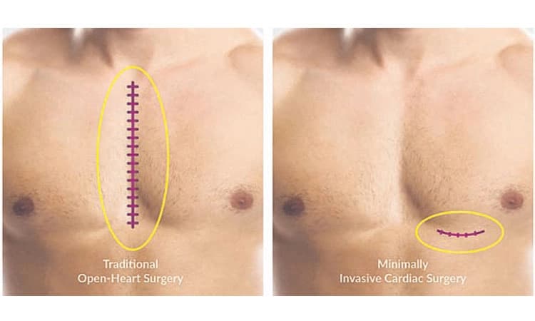 Heart Surgery: ಕಡಿಮೆ ಗಾಯದ ಹೃದಯ ಶಸ್ತ್ರಚಿಕಿತ್ಸೆ