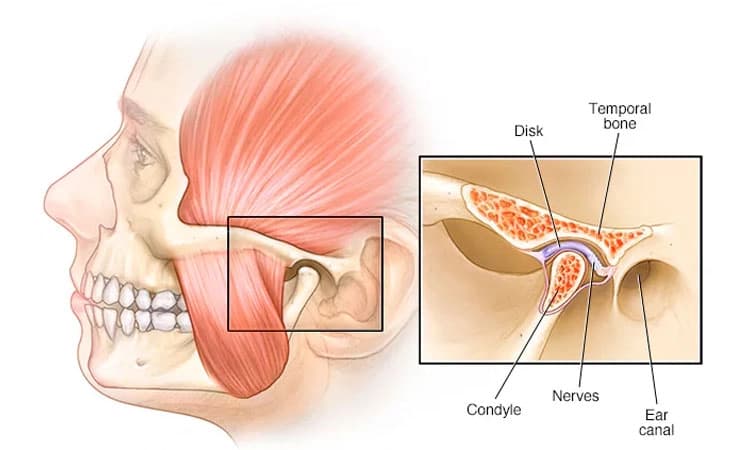 ಕೆಳಗಿನ ದವಡೆ ಮತ್ತು ತಲೆಬುರುಡೆ (TMJ)ಯ ಕೀಲು ಬೆಸುಗೆ;ಕಾರಣಗಳು, ಲಕ್ಷಣಗಳು ಮತ್ತು ಚಿಕಿತ್ಸೆ