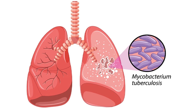 Tuberculosis: ಕ್ಷಯ ರೋಗದ ವಿರುದ್ದ ಅಭಿಯಾನ