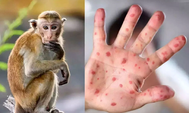 Monkey disease: ಮಂಗನ ಕಾಯಿಲೆ ಆತಂಕ: ದ. ಕ. ಜಿಲ್ಲೆಯಲ್ಲಿ ಮುನ್ನೆಚ್ಚರಿಕೆ