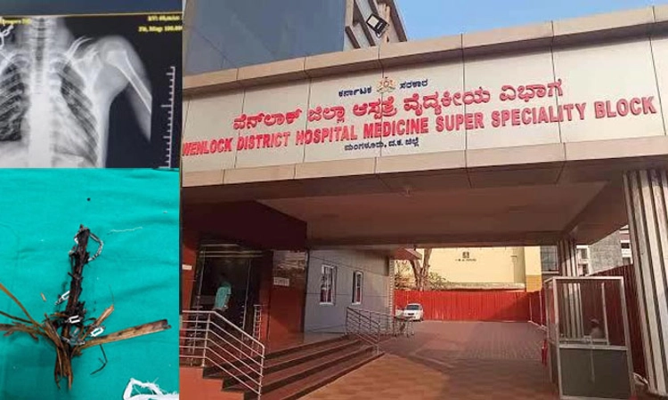 Mangaluru: ತೆಂಗಿನ ತುಂಡು ಎದೆಗೆ ಹೊಕ್ಕಿದ್ದ ಬಾಲಕ ಚೇತರಿಕೆ