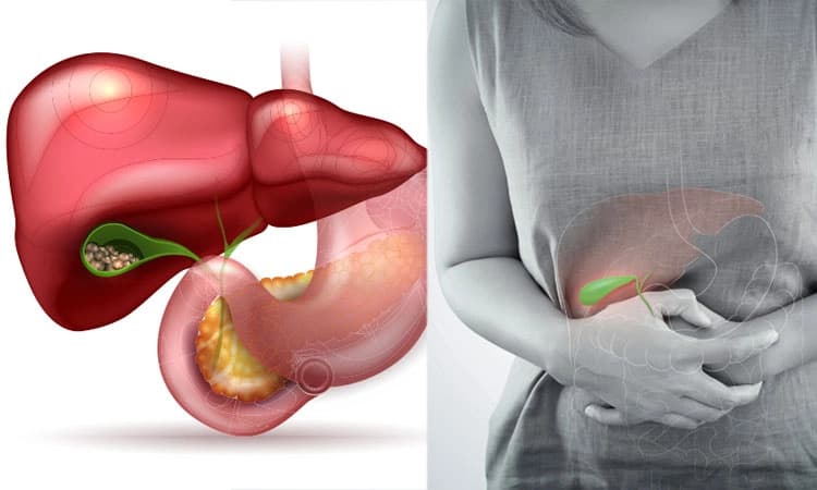 Gallstones: ಪಿತ್ತಕೋಶದ ಕಲ್ಲುಗಳು