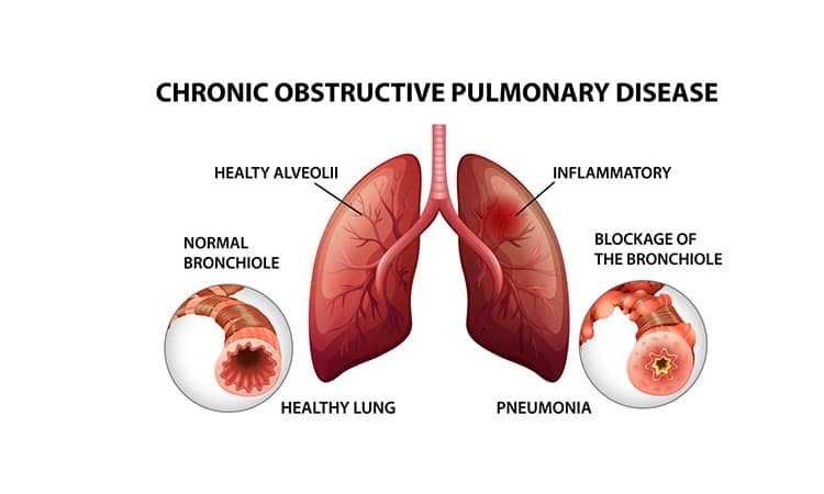 COPD: ಕ್ರೋನಿಕ್‌ ಒಬ್‌ಸ್ಟ್ರಕ್ಟಿವ್‌ ಪಲ್ಮನರಿ ಡಿಸೀಸ್‌ (ಸಿಒಪಿಡಿ)