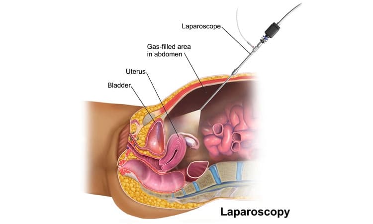 Laparoscopic surgery: ಸಂತಾನೋತ್ಪತ್ತಿ ಹೆಚ್ಚಿಸುವ ಲ್ಯಾಪರೊಸ್ಕೋಪಿಕ್ ಶಸ್ತ್ರಚಿಕಿತ್ಸೆ