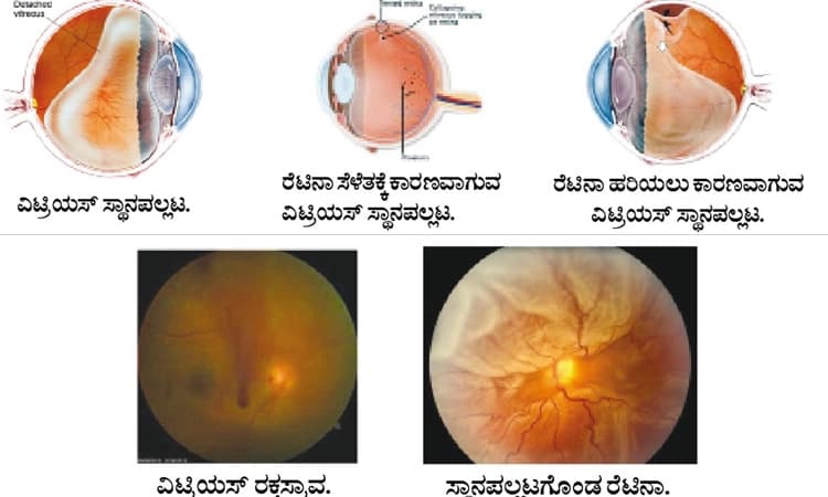 ಕಣ್ಣಿನಲ್ಲಿ ತೇಲುಬಿಂಬಗಳು