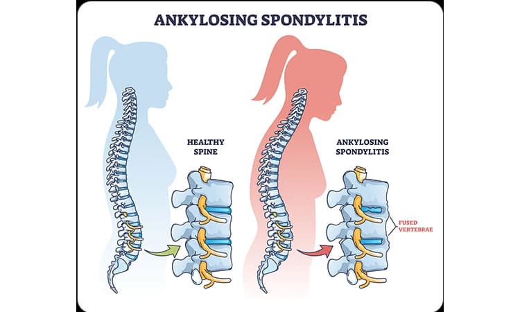 Ankylosing Spondylitis: ಹಾಗೆಂದರೇನು ? ಕಾರಣವೇನು ? ಚಿಕಿತ್ಸೆ ಹೇಗೆ