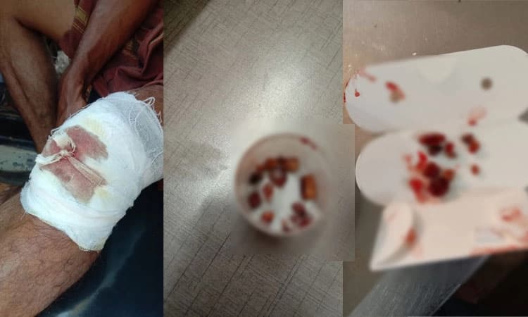 ಕಡಬ ಸಮುದಾಯ ಆಸ್ಪತ್ರೆ ಸಿಬ್ಬಂದಿಯ ಎಡವಟ್ಟು! ಗಾಯದೊಳಗೆ 14 ಕಲ್ಲುಗಳು!