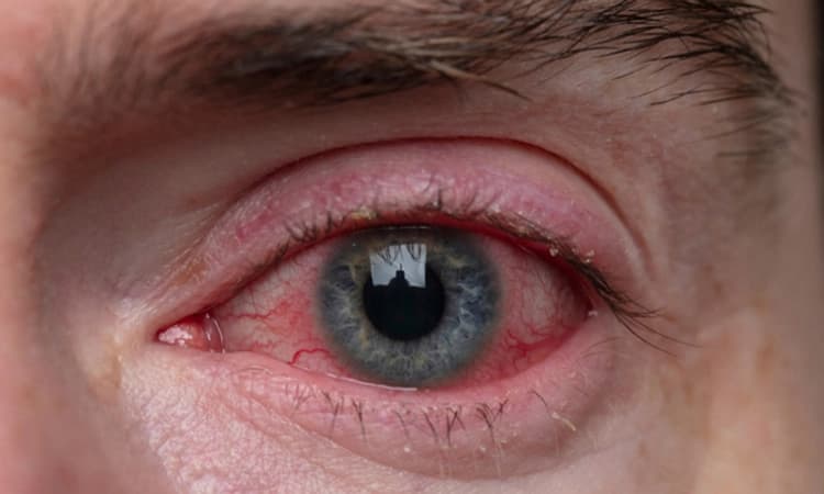 ಮಂಗಳೂರಿನಲ್ಲಿ ಕೆಂಗಣ್ಣು: ಗಡಿಯಲ್ಲಿ ಮುನ್ನೆಚ್ಚರಿಕೆ, ಬೆಳ್ತಂಗಡಿಯಲ್ಲೂ ಕೆಂಗಣ್ಣು ಭೀತಿ