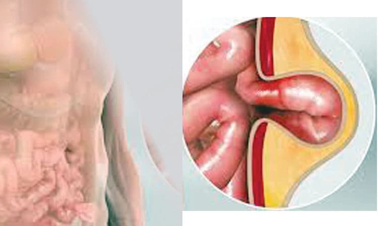 ಹರ್ನಿಯಾ ಕಾಯಿಲೆಗೆ ಶಸ್ತ್ರ ಚಿಕಿತ್ಸೆ ಅನಿವಾರ್ಯವೇ ?