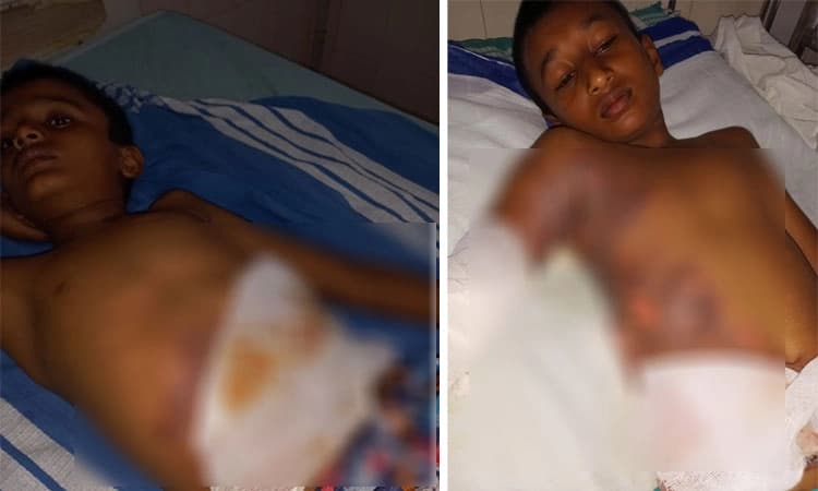 ಹೆಬ್ರಿ ಆಶ್ರಮ ಶಾಲೆ ಹಾಸ್ಟೆಲ್ ನಲ್ಲಿ ಅಗ್ನಿ ಅವಘಡ; 4 ವಿದ್ಯಾರ್ಥಿಗಳು ಆಸ್ಪತ್ರೆಗೆ ದಾಖಲು