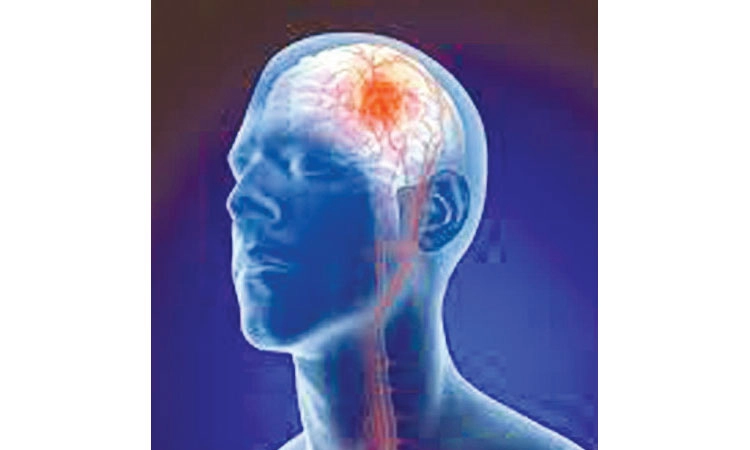 ನಿಶ್ಶಬ್ದ ಲಕ್ವಾ ಎಂದರೇನು? ಕಾರಣಗಳು ಮತ್ತು ತಡೆ