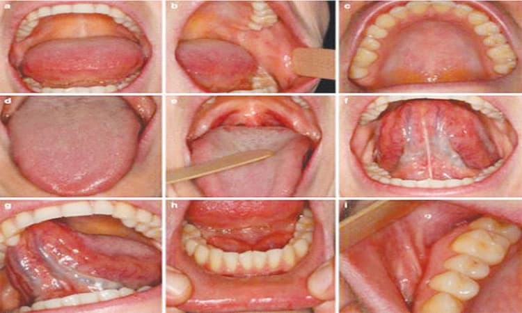 ಬಾಯಿ ಕ್ಯಾನ್ಸರ್‌ನ ಲಕ್ಷಣಗಳು ಮತ್ತು ತಡೆಯುವ ಕ್ರಮಗಳು