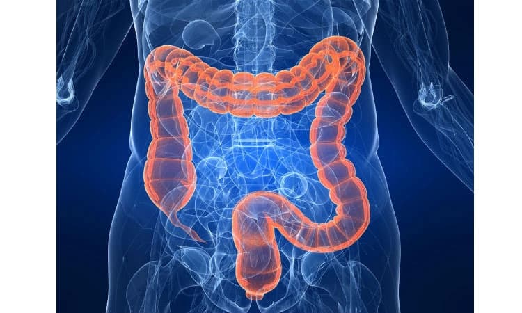 ಆರೋಗ್ಯ: ದೊಡ್ಡ ಕರುಳಿನ ಕ್ಯಾನ್ಸರ್‌ ಬಗ್ಗೆ ಅರಿಯಿರಿ