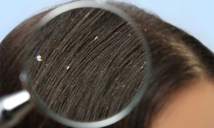 ತಲೆ ಹೊಟ್ಟಿನ ಸಮಸ್ಯೆ ಕಾಡುತ್ತಿದೆಯಾ? ಈ ಸಮಸ್ಯೆ ನಿವಾರಣೆಗೆ ಸುಲಭ ಮನೆಮದ್ದು