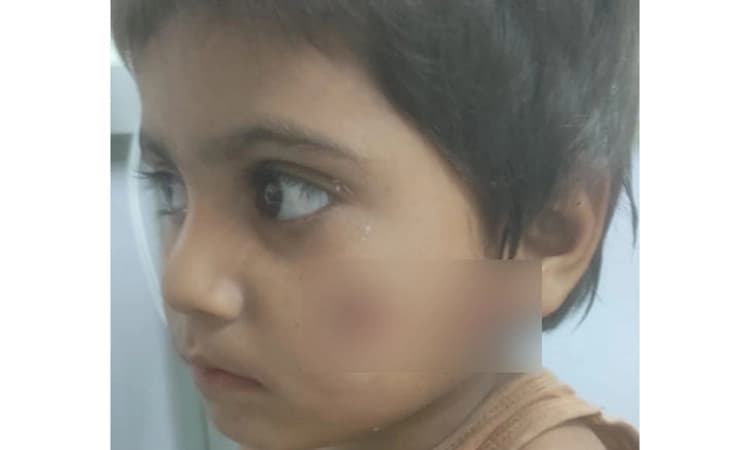 ಬಳ್ಳಾರಿ: ಹುಚ್ಚು ನಾಯಿಯಿಂದ ಕಡಿತಕ್ಕೊಳಗಾಗಿದ್ದ ಮಗು ಸಾವು