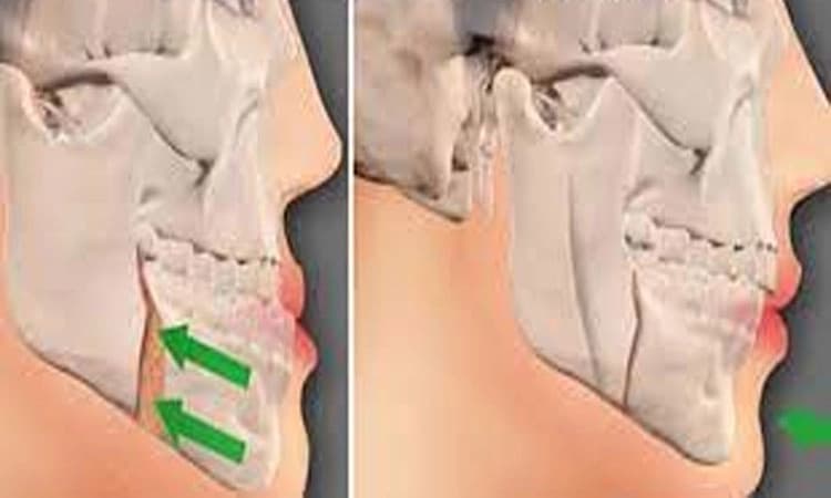 ಆರೋಗ್ಯ ವಾಣಿ- ಮ್ಯಾಕ್ಸಿಲೊಫೇಶಿಯಲ್‌ ಗಾಯಗಳು: ಕಾರಣಗಳು, ತಡೆ ಮತ್ತು ಚಿಕಿತ್ಸೆ