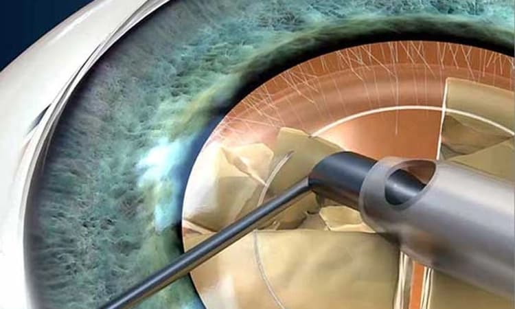 ಕಣ್ಣಿನ ಪೊರೆ ನಿವಾರಣೆಗೆ ವರದಾನ ಫೇಕೊ ಇಮಲ್ಸಿಫಿಕೇಶನ್‌