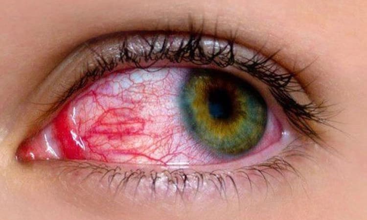 ಉಡುಪಿ ಜಿಲ್ಲೆಯಲ್ಲಿ ಕೆಂಗಣ್ಣು ಬೇನೆ, ಜ್ವರ ಬಾಧೆ