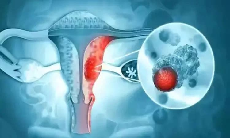 ಗರ್ಭಕಂಠದ ಕ್ಯಾನ್ಸರ್‌: ಕಾರಣಗಳು,ರೋಗಲಕ್ಷಣಗಳು, ತಡೆಗಟ್ಟುವಿಕೆ ಮತ್ತು ಚಿಕಿತ್ಸೆ