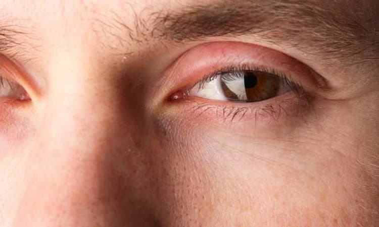 Health Tips: ಕಣ್ಣಿನ ಊತ ಕಡಿಮೆ ಮಾಡಿಕೊಳ್ಳುವುದು ಹೇಗೆ ?