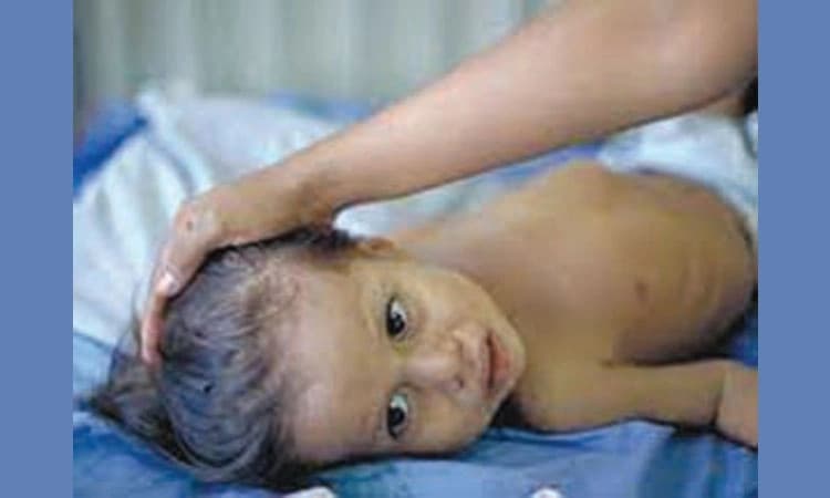 ಬಾಲ್ಯಕಾಲದ ಕ್ಷಯ; ರೋಗಪತ್ತೆ, ಚಿಕಿತ್ಸೆ ಮತ್ತು ನಿರ್ವಹಣೆಯ ಸವಾಲುಗಳು