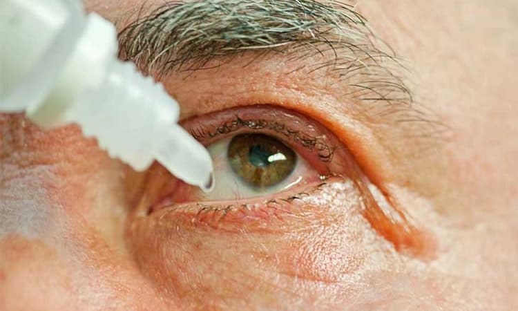 ಅಲರ್ಜಿಯಿಂದಾಗುವ ಕಣ್ಣಿನ ತುರಿಕೆಗೆ ಸುಲಭ ಪರಿಹಾರ