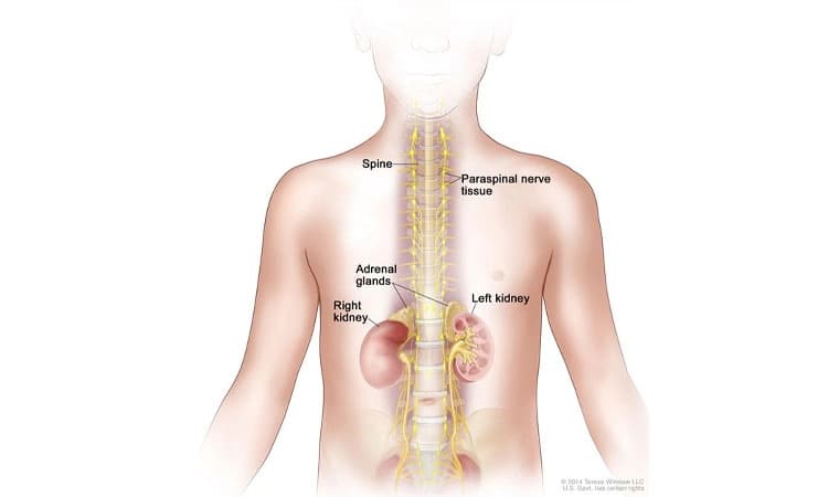 ನ್ಯುರೊಬ್ಲಾಸ್ಟೊಮಾ ಉತ್ತಮ ಗುಣ ಕಾಣುವುದಕ್ಕೆ ಉತ್ತಮ ಚಿಕಿತ್ಸೆ ಅಗತ್ಯ