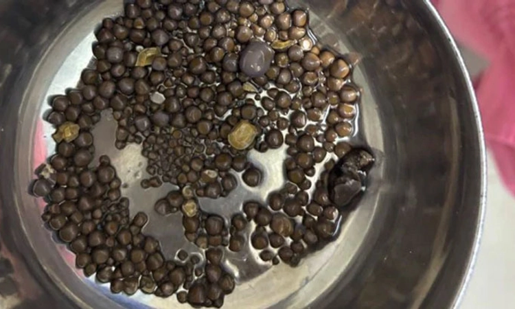 Shock!; ವ್ಯಕ್ತಿಯ ಕಿಡ್ನಿಯಿಂದ 418 ಕಲ್ಲು ಹೊರತೆಗೆದ ವೈದ್ಯರು