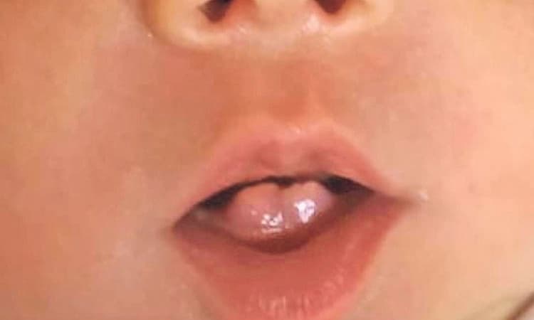 ಮಂಗಳೂರು : ಹುಟ್ಟುವಾಗಲೇ ನವಜಾತ ಶಿಶುವಿನಲ್ಲಿ ಹಲ್ಲು! ವೈದ್ಯರು ಹೇಳಿದ್ದೇನು ಗೊತ್ತೆ ?