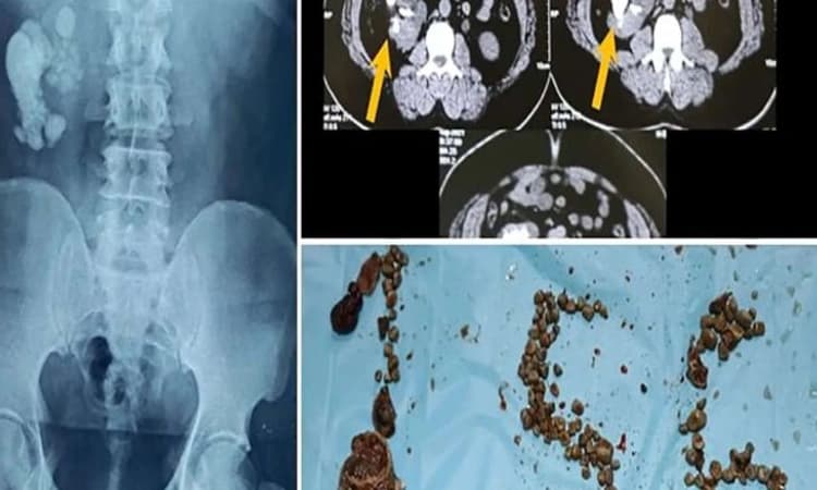 ಹುಬ್ಬಳ್ಳಿಯ ವ್ಯಕ್ತಿಯ ಮೂತ್ರಪಿಂಡದಲ್ಲಿತ್ತು ದಾಖಲೆಯ 156 ಕಲ್ಲುಗಳು !