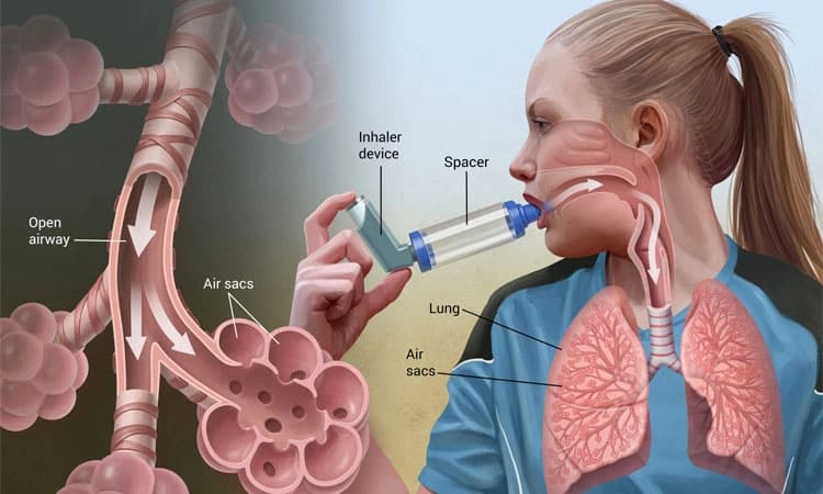 Asthma ಕುರಿತಾದ ಶಿಕ್ಷಣದಿಂದ ಸಶಕ್ತೀಕರಣ; ಜಾಗತಿಕ ಅಸ್ತಮಾ ದಿನ 2024: ಮೇ 7