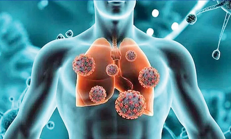 HMPV ಸೋಂಕಿಗೆ ಆತಂಕ ಬೇಡ: ಐಸಿಎಂಆರ್‌