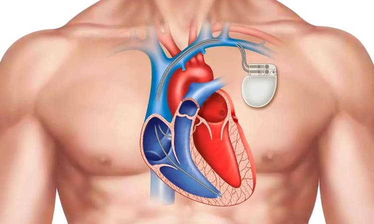 Heart Rate Control: ಹೃದಯ ಬಡಿತದ ನಿಯಂತ್ರಣದಲ್ಲಿ ಆಧುನಿಕ ಹೃದಯ ಲಯ ಸಾಧನಗಳ ಅಗತ್ಯ ಪಾತ್ರ