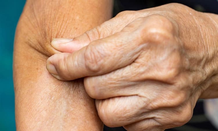 Scleroderma: ಸ್ಕ್ಲೆರೋಡರ್ಮಾ ಜತೆಗೆ ಜೀವಿಸುವುದು