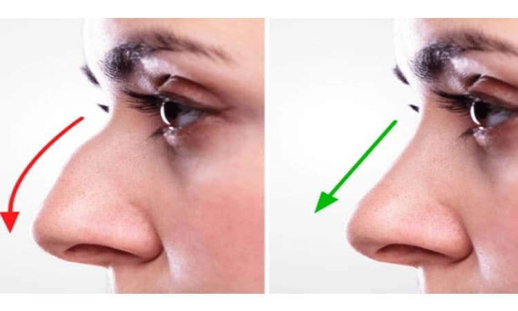 Rhinoplasty: ರಿನೊಪ್ಲಾಸ್ಟಿ
