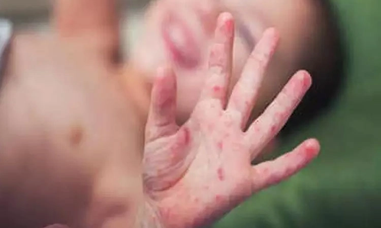 Disease: ಡೆಂಘೀ ಜತೆ ಮಕ್ಕಳ ಕಾಡುತ್ತಿದೆ ಕಾಲು ಬಾಯಿ ರೋಗ!