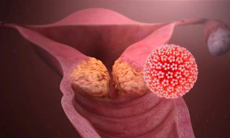 HPV: ಹ್ಯೂಮನ್‌ ಪ್ಯಾಪಿಲೋಮಾವೈರಸ್‌ (ಎಚ್‌ಪಿವಿ) ಮತ್ತು ಗರ್ಭಕಂಠದ ಕ್ಯಾನ್ಸರ್‌