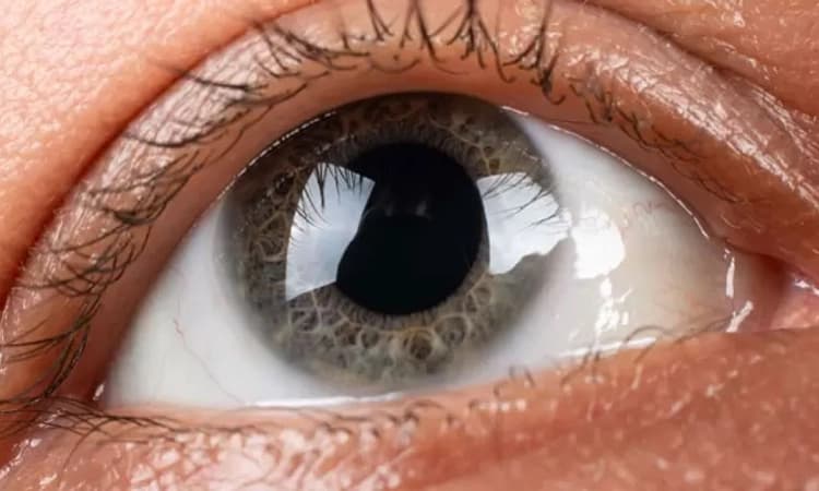 Eye; ಪದೇ ಪದೆ ಕಣ್ಣುಜ್ಜುತ್ತಿದ್ದ ಮಲೇಷ್ಯಾ ವ್ಯಕ್ತಿಗೆ ಕಾರ್ನಿಯಾ ಕಸಿ