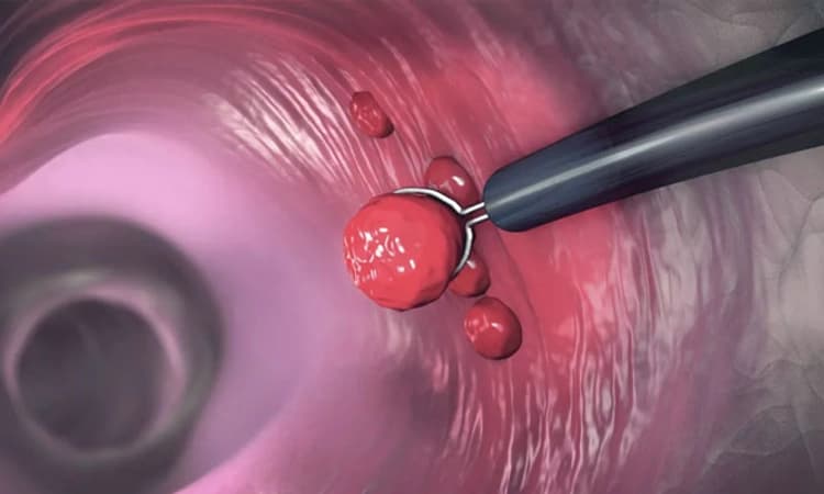 Colon Cancer; ಸಂಕೇತಗಳು ಮತ್ತು ಲಕ್ಷಣಗಳು, ರೋಗನಿರ್ಣಯ ಮತ್ತು ಚಿಕಿತ್ಸೆ