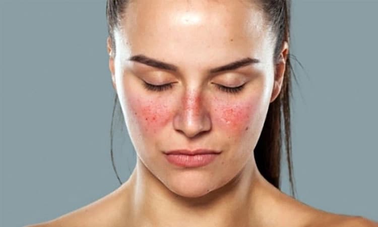 Lupus: ಲೂಪಸ್‌ ಜತೆಗ ಜೀವನ