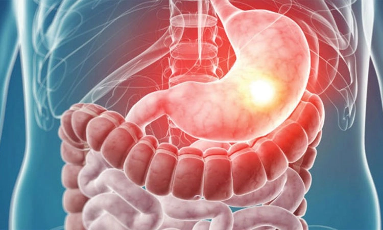 Gastroenteritis: ಹೊಟ್ಟೆಗೆ ಜ್ವರ ಬಂದರೆ…!