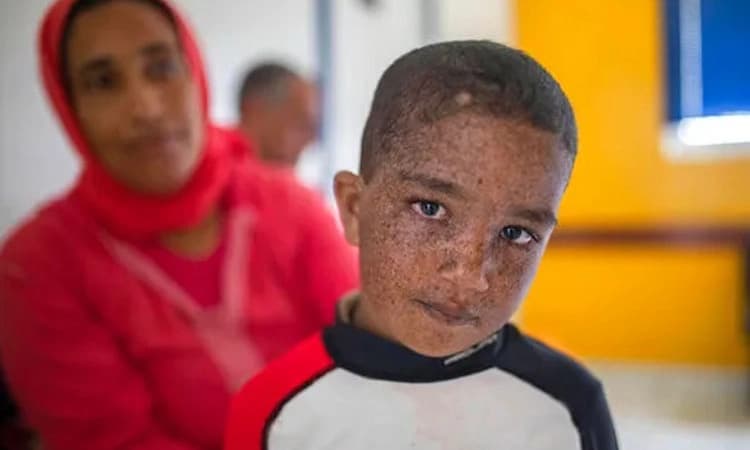 Health: ಜೆರೋಡರ್ಮಾ ಪಿಗ್ಮೆಂಟೋಸಂ ಎಂಬ ಮಾರಣಾಂತಿಕ ಚರ್ಮ ರೋಗ