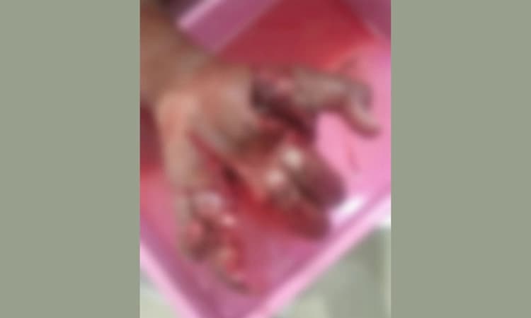 Chikodi; ಪಟಾಕಿ ಸಿಡಿಸುವ ವೇಳೆ ಯುವಕನ ಕೈ ನುಜ್ಜು ಗುಜ್ಜು