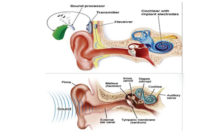 Auditory Neuropathy: ಶಿಶುಗಳಲ್ಲಿ ಆಡಿಟರಿ ನ್ಯುರೋಪತಿ ಸ್ಪೆಕ್ಟ್ರಮ್‌ ತೊಂದರೆಗಳು