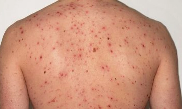 Measles: ಕರಾವಳಿಯಲ್ಲಿ ಉಲ್ಬಣಿಸಿದ ದಡಾರ… ಕಳೆದ ವರ್ಷದಿಂದ ಈ ಬಾರಿ ಏರಿಕೆ!