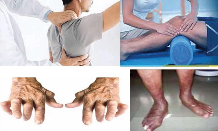 Arthritis: ಸಂಧಿವಾತದ ನಿರ್ವಹಣೆಯಲ್ಲಿ ಫಿಸಿಯೋಥೆರಪಿಯ ಪಾತ್ರ